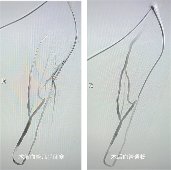 球囊