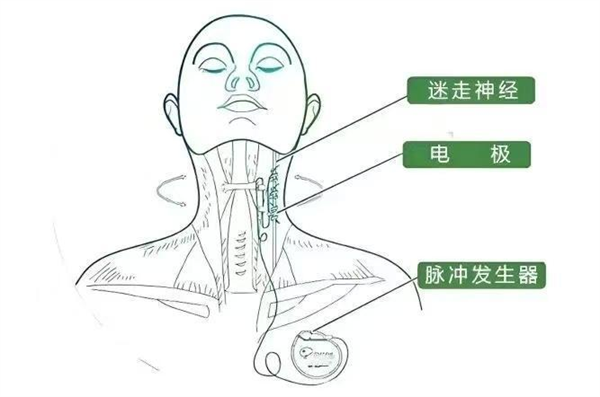 卒中3
