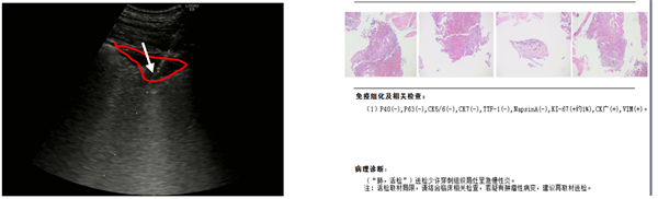肺活检2