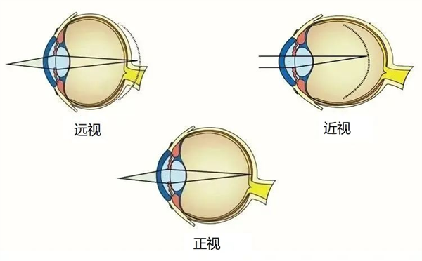 视力1